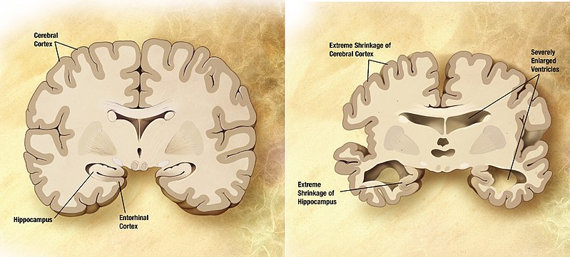 Brain scan showing a normal brain and one with Alzheimer's, which has significant decay on the sides and lower portions of the brain. It shows a smaller hippocampus, shrinking cerebral cortex, and enlarged ventricles.