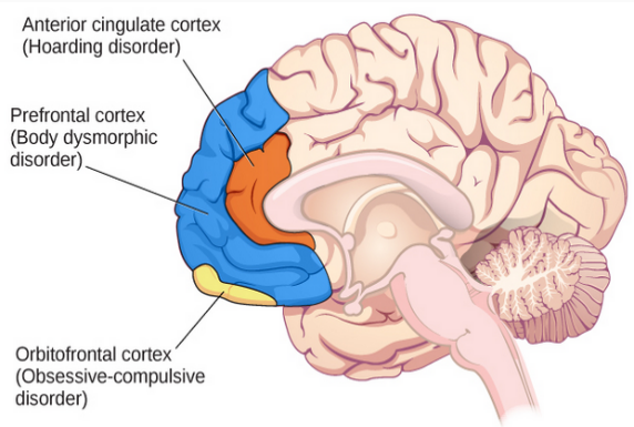 Picture of sideview of brain. Front regions are highlighted. At very forefront, right behind forehead is prefrontal cortex with a label suggesting implications in body dysmorphic disorder. Behind the prefrontal cortex is the anterior cingulate cortex with a label suggesting an implication in hoarding disorder. At the bottom of the prefrontal cortex is a small part called the orbitofrontal cortex with a label suggesting an implication in obsessive compulsive disorder.